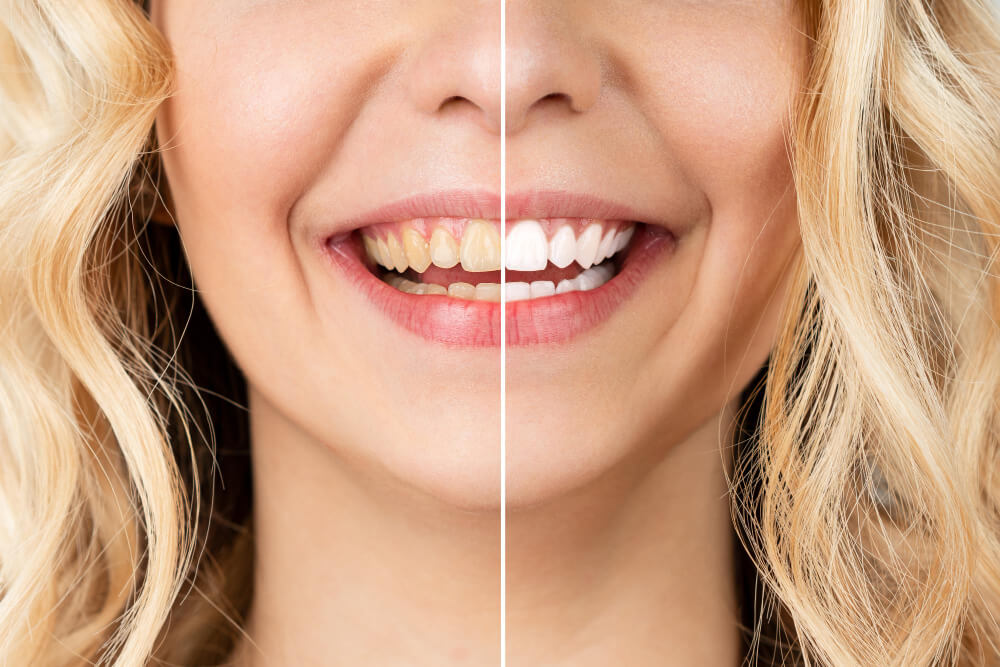 Prečo podstúpiť procedúru bielenia zubov?