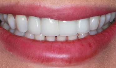 Porovnanie úsmevu pred a po nasadení faziet, ktoré efektívne uzavreli medzery medzi prednými zubami.