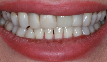 Detailný záber na zuby pred a po aplikácii zubných faziet na Aurel Clinic, ktoré opravili nejednotnú farbu a mierne nerovnosti.