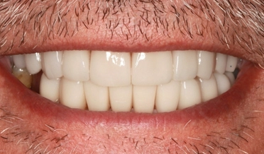 Celková estetická premena úsmevu na Aurel Clinic s použitím zubných faziet pre dosiahnutie žiarivo bieleho vzhľadu.