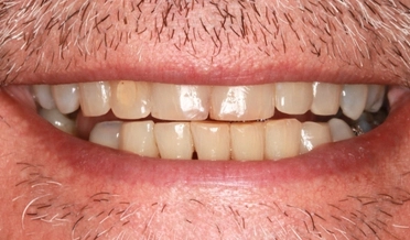 Fotografia zachytáva opravu mechanicky poškodených a odštiepených predných zubov pomocou keramických faziet.