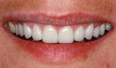 Detailný pohľad na fazety, ktoré dokonale imitujú prirodzenú štruktúru a priesvitnosť ľudského zuba.