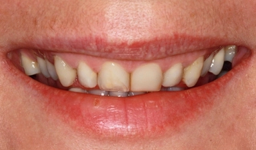 Celkový pohľad na tvár pacientky pred a po aplikácii faziet, zachytávajúci zmenu výrazu a úsmevu.